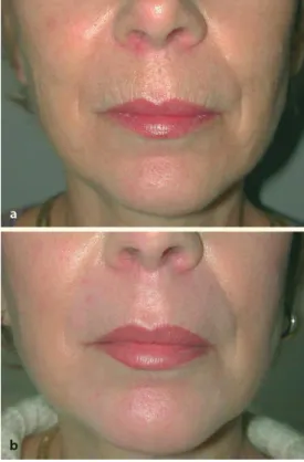 Fig. 1.10.  a Before and b 3 months aft er full facial er- er-bium laser resurfacing and fat transfer