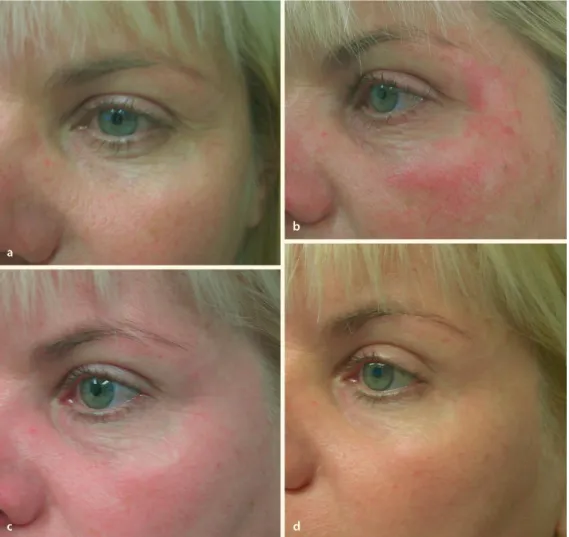 Fig. 1.18  a–d.  Patient treated with Portrait plasma skin resurfacing at a baseline, b 1 week, c 6 weeks, and d 3 months aft er the procedure