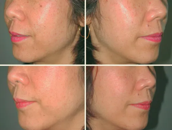 Fig. 1.26.  Patient with epidermal pigmentation, before (top) and aft er (bottom) two treatments with a long-pul- long-pul-sed laser