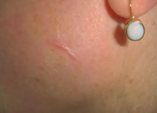 Fig. 1.40.  Scar aft er CO 2  and erbium laser resurfacing