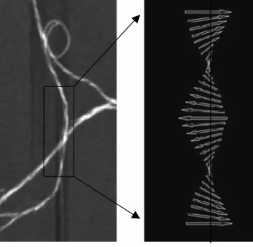 FIGURE 1.2 Atomic force microscopy (AFM) image of amyloid ﬁ brils (A) and outline of the ordered core structure (B) of one of the interwoven protoﬁlaments constituting the ﬁbril.