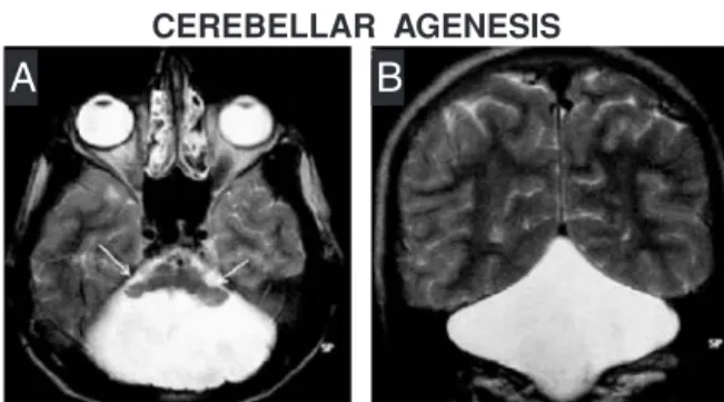 Figure 7.1 Cerebellar agenesis. Top panels: Magnetic resonance axial (A) and coronal (B) T2-weighted imaging in a patient with ataxia and nystagmus