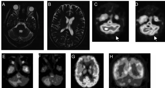 Figure 9.1 Auto-immune polyglandular syndrome (APS) type 2 in a young man presenting with a disabling cerebellar syndrome