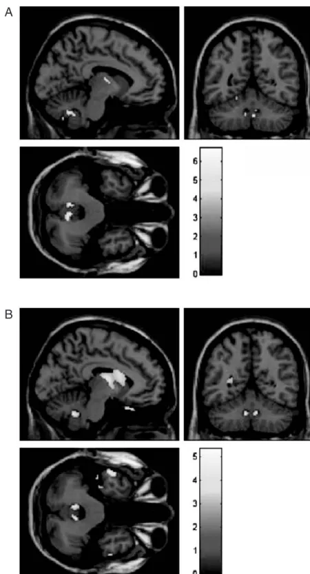 Figure 11.2 Cerebellar involvement in Creutzfeldt-Jakob disease. The larger cerebellar loci of significantly elevated apparent diffusion coefficient (ADC) and CSF volume (respectively in A and B) are found bilaterally in the cerebellar nodule, shown here i