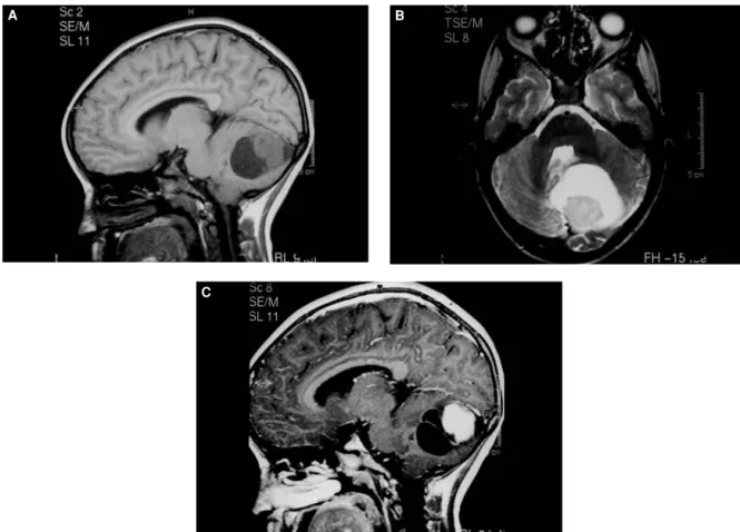 Figure 13.2 Left cerebellar cystic grade II astrocytoma. On T1-weighted sequence (A), the tumor appears as a partially cystic mass causing tonsillar herniation