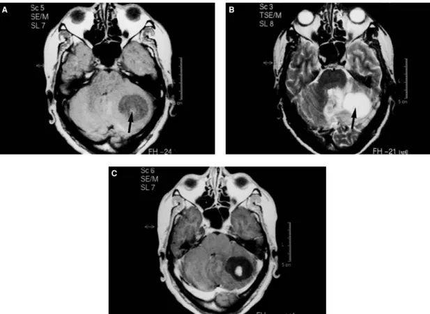 Figure 13.4 Cerebellar hemangioblastoma. (A) Axial T1-weighted sequence shows a cystic lesion with a small isointense nodule (arrow).