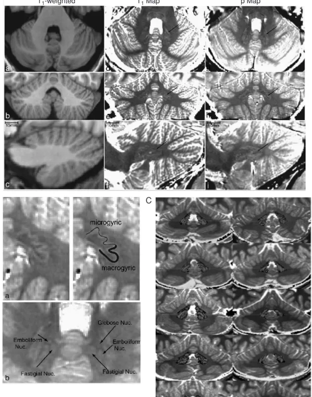 Figure 1.12 Imaging of cerebellar nuclei in adults using high-resolution MRI. (A) (a–c) Axial, coronal, and sagittal slices of the human cerebellum and corresponding slices through the high-resolution (0.7 × 0.7 × 0.7 mm 3 voxels) " (d–f) and T1 (g–i) 