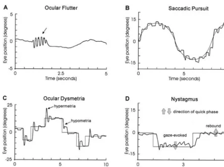Figure 3.1 Oculomotor disturbances in cerebellar patients recorded with electrooculography (EOG)