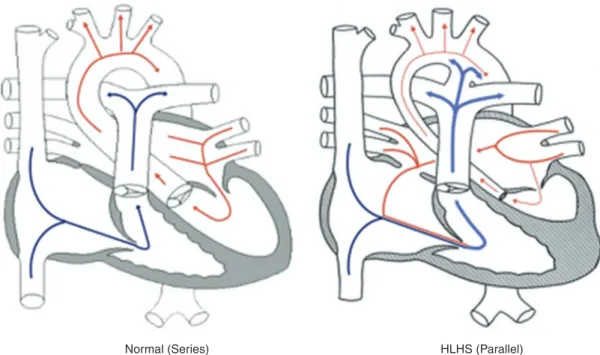 Fig. 7.1  A comparison of a normal series circulation to a HLHS parallel circulation