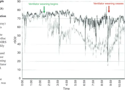 Fig. 3.3  An example  of near-infrared  spectroscopy (NIRS)  trends during  mechanical ventilation  weaning