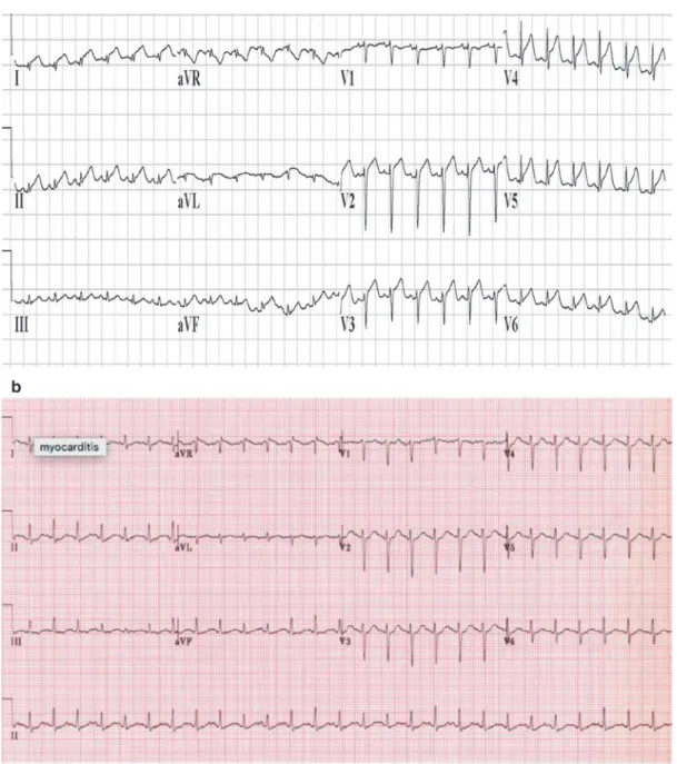 Fig. 5.2 (a) ECG of a patient with myocarditis demon- demon-strating a low-voltage rhythm (requiring double standard  calibration) along with diffuse, nonspecific S-T 