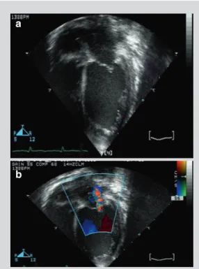 Fig. 5.3 (a) Fulminant myocarditis  – echocardio- echocardio-graphic image, apical four-chamber view
