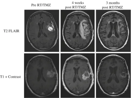 Fig. 6.1 Imaging evidence of pseudoprogression at 4 weeks after radiation therapy and temozolo- temozolo-mide
