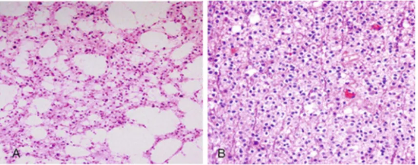 Fig. 8.1 Histopathological features of low-grade gliomas. (a) Diffuse astrocytomas (WHO grade II) displaying low cellularity and cellular atypia