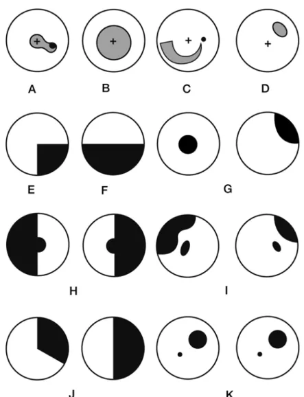 Fig. 4.3 (a–f) Retinal or optic nerve lesions. (a) Cecocentral  scotoma.  (b)  Central  scotoma