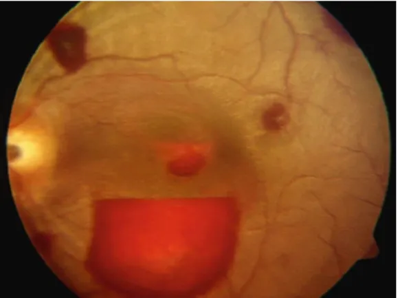 Fig.  4.8 Subhyaloid  (preretinal)  hemorrhage.  This  is  located  under  the  preretinal  membrane  and  above  the  nerve fiber layer