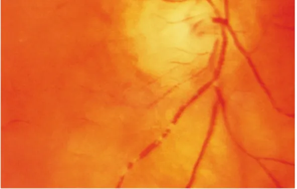 Fig.  4.7 Hollenhorst  plaque.  Bright  yellow  cholesterol  embolus  lodged  at  a  bifurcation  of  the  superior  retinal  artery
