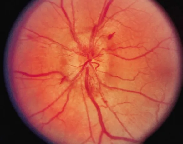 Fig. 4.6 Optic neuritis. Blurred disk margins and hemor- hemor-rhage adjacent to the inferior portion of the optic diskFig
