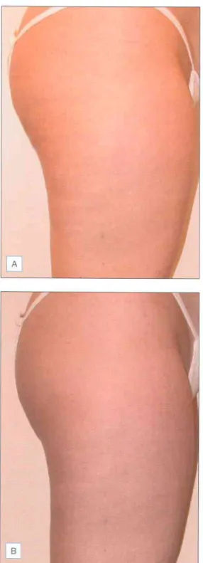 Fig. 6.11 Cellulite  treatment  with Triactive Subject betore (A) and following  10 treatments  (B)  (Reproduced  with permission  from: Boyce S, Pabby A, Chuchaltkaren  P, Brazzini  B, Gotdman MP 2OO5  Clinical evaluation  of a device for the treatment  o