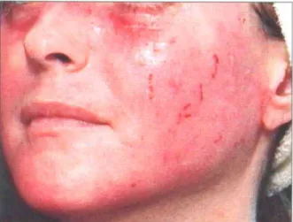 Fig. 7.2 Contact dermatitis  is a relatively  common side effect of laser skin resurfacing  because of the impairment  of the protective epidermal  barrier that occurs with skin ablation Topical antibiotics  and other irritants  should be avoided in the im
