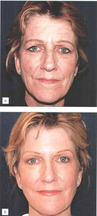 Fig. 1.2 Remarkable  improvement  of facial rhytides (A) Before treatment (B) 3 months posttreatment