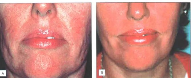 Fig. 1.3 Atrophic  acne scarring.  (A) Before treatment.  (B) 3 months post-treatment