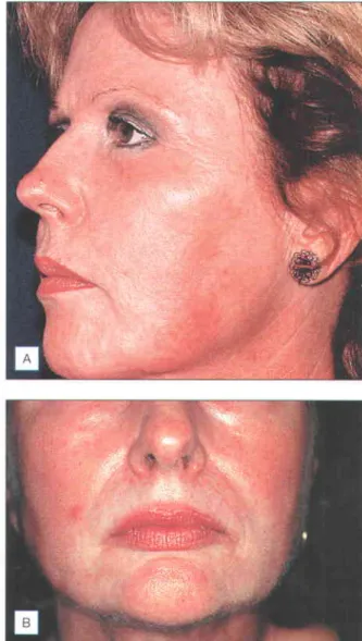 Fig. 1.16 Petechia  on the cheek  of a patient  appearing  in the first 2 weeks  post-treatment  These  were  most  likely  caused  by scratching