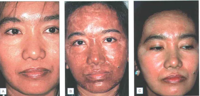 Fig. 1.18 Postresurfacing  hyperpigmentation  in a patient  with type lV skin. (A) Before treatment