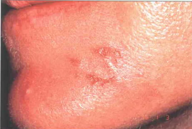 Fig. 1.19 Erosions  and crusts on the chin caused by Staphyloccus aureus poslresurfacing