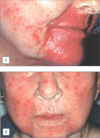 Fig. 1.20 (A) Culture proven HSV after CO2 resurfacing (B) Disseminated  HSV in a patient after COz resurfacing  which resulted  in significant  scarring
