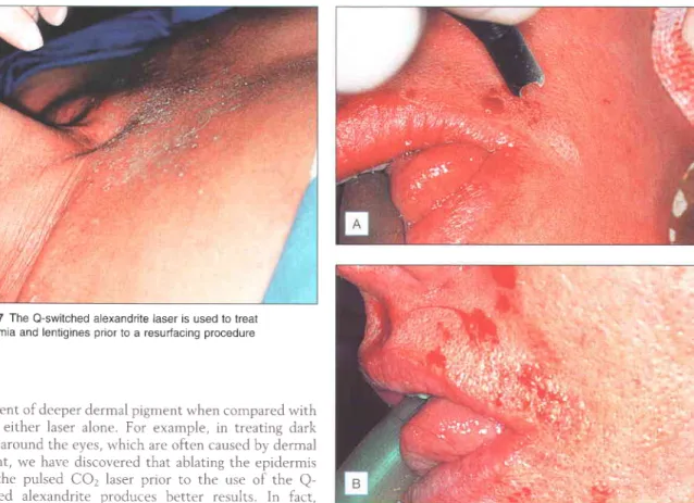 Fig. 1.27 The O-switched  alexandrite  laser is used to treat dyschromia  and lentigines  prior to a resurfacing  procedure