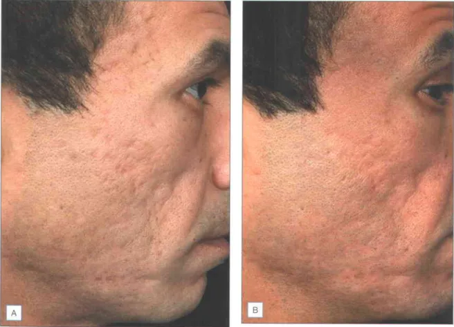 Fig. 2.3 Results after a series of four Fraxel SR 1 500rM  skin-resurfacing  treatments  at 40 mJ spaced one month apart for acne scarring The patient has achieved significant  improvement (Photos  courtesy  ol Dr  Zakia Rahman)