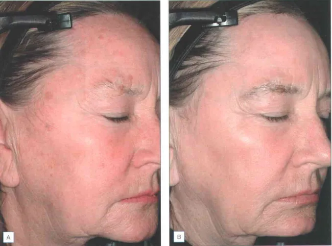 Fig. 2.4 Patient  before (A) and after (B) a series of three low-energy  plasma skin regeneration  (PSR) treatments  with good improvemenl  in dyspigmentation  and overall skin tone  (Photos courtesy  ol Dr