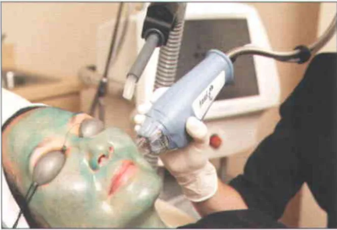 Fig. 2.5 Fractional  photothermolysis  treatment-the  area is lightly coated with a water-soluble  blue dye (OptiGuiderM  Blue, Relianl Technologres,  Mountain  View, CA), which allows the laser
