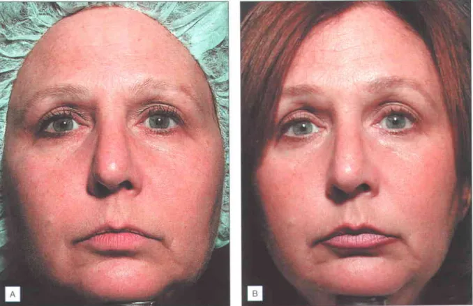 Fig. 4.4 Eyebrow lift following  Thermage  treatment,  Photographic  example of patlent prior to treatment  (A) and 4 weeks post-treatment  (B)