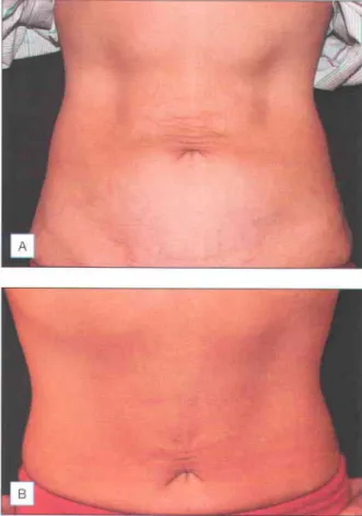 Fig. 4.13 Tightening  of abdominal  skin with ThermaCool  TC  Patient prior to (A) and 1 year following  (B) one pass at 15.5
