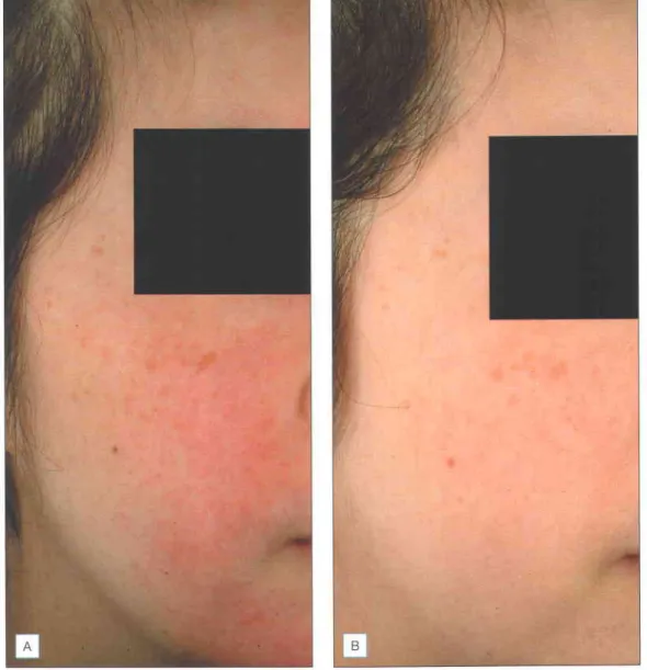 Fig. 5.9 lmprovement  ol rosacea  after seventh lreatment  with long pulsed dye laser (595 nm, 1 0 ms, 7 5 Jlcm2  , 1 0-mm spot size)