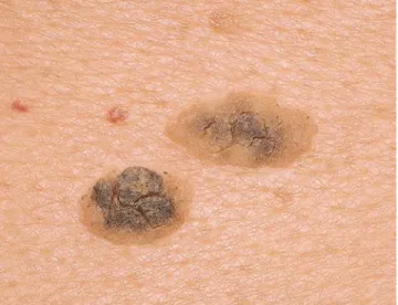FIGURE 3-1 Seborrheic keratoses usually appear at approximately  the fifth decade of life and gradually increase in number with age