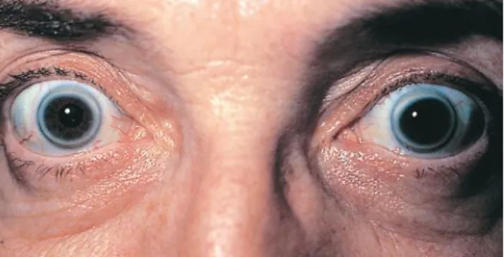 FIGURE 3-10 Arcus senilis. (From Yanoff M, Fine BS: Ocular  pathology, St. Louis, 2002, Mosby.)