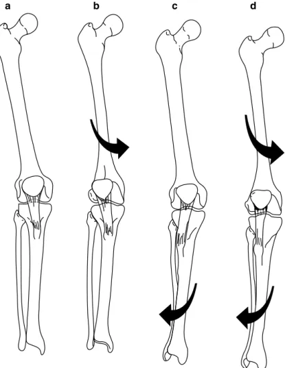 Bone Abnormalities - Pathophysiology of Lateral Patellar Dislocation