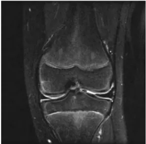 Figure  11C Coronal  T2-weighted  fat-saturated  image  of  a  14-year-old  ballet  dancer  shows  the  lateral  meniscus  to  be more  substantial  than  the  medial  in  all  dimensions  (i.e., height  and  width),  while  extending  more  centrally  tha