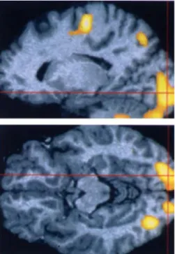 Figure 2.5 PET evidence of activation in visually deprived occipital cortex in early-blind subjects during a Braille reading task