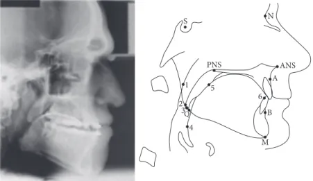 Fig. 3.2  Common cephalometric measurements in patients with obstructive sleep  apnoea
