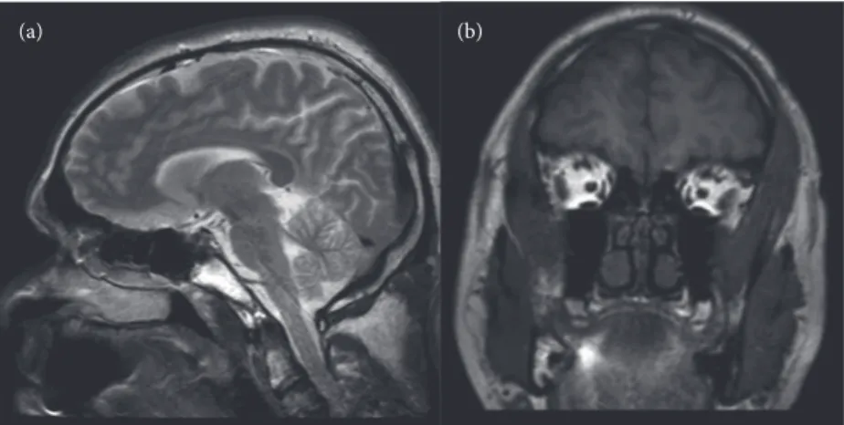 Fig. 6.1  MRI head sagittal section (a) and coronal section (b) showing complete  occlusion of upper airway at the back of the tongue and soft palate.