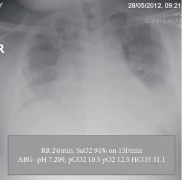 Fig. 12.1   Difficult to interpret portable chest radiograph, but showing no collapse  consolidation or pulmonary oedema in patient with acute hypercapnic respiratory  failure.