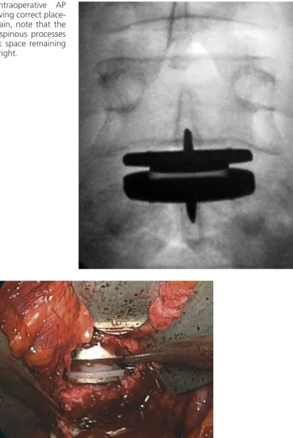 FIGURE  7-18  Final  intraoperative  AP  fluoroscopic image showing correct  place-ment of the device