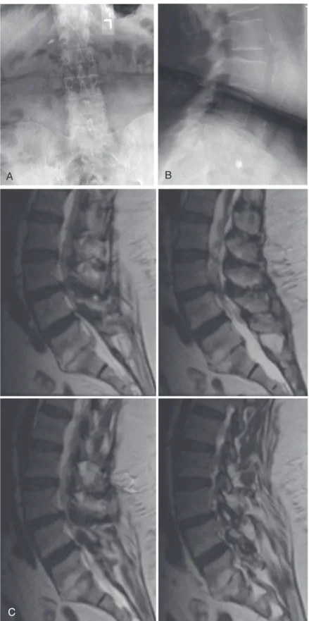 FIGURE  8-1    Preoperative  images  showing  grade  I  spondylolisthesis  at  L3-4. A,  Anteroposterior  radio- radio-graph of lumbar spine
