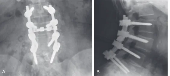 FIGURE 8-2  Postoperative images showing placement of instrumentation. A, AP radiograph of lumbar spine