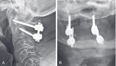 FIGURE 11-2  Postoperative lateral (A) and AP (B) radiographs demonstrating fracture reduction with C1  lateral mass and C2 pars instrumentation.