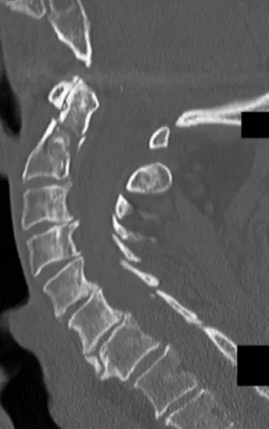 FIGURE 12-1  Sagittal CT image showing an odontoid fracture at  the time of injury.